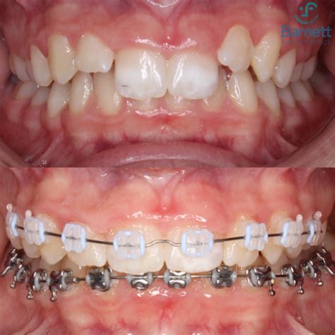 barnett orthodontics blog invisalign braces and more in