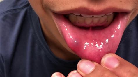 popping  lip cyst mucocele  symptoms  treatment extended