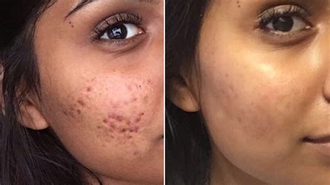 controversial cystic acne routine  viral