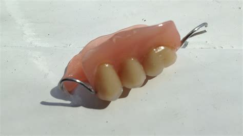 fileprothese dentaire partielle en resinejpg wikimedia commons