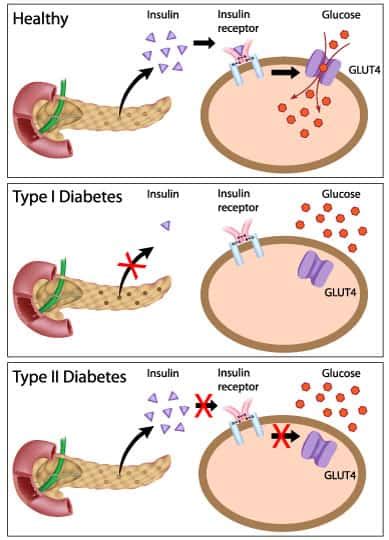 Beta Cells And Diabetes