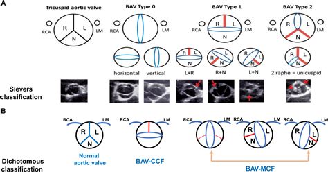 Frontiers Bicuspid Aortic Valve An Update In Morphology Genetics