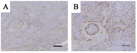 concurrent expression of c4 4a and tenascin c in tumor cells relates to poor prognosis of