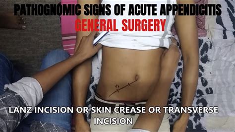 pathognomic signs  acute appendicitis general surgery youtube