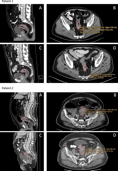 frontiers computertomography based prediction of complete response