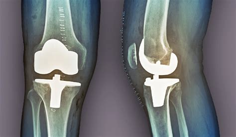 examining total knee arthroplasty outcomes  patients  lupus