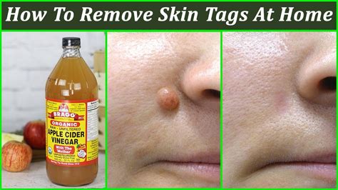how to remove skin tags at home 7 best skin tag removal ideas