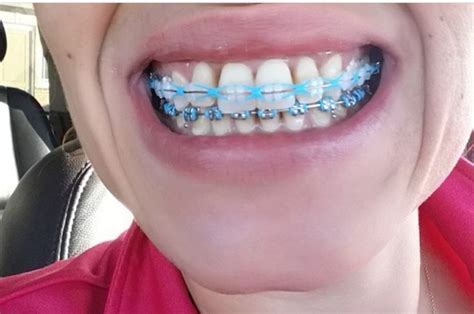 pin by evil h on beautiful braces braces colors cute braces braces