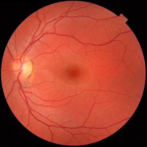 definition  retina hubpages