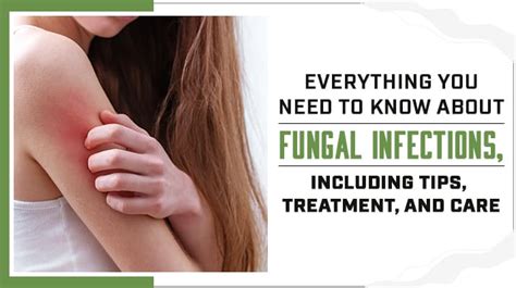 fungal infections including tips