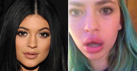 experts kylie jenner lip challenge is dangerous and damaging cbs