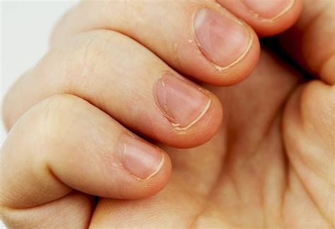 white spots  leukonychia  childs nails symptoms home remedies