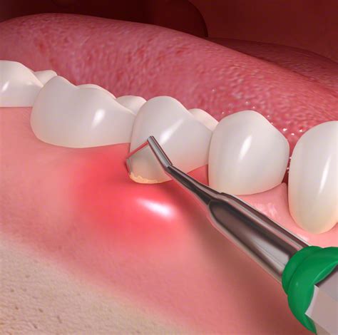 deep cleaning scaling ward periodontics