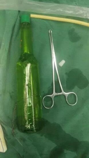 Man Has Seven Inch Glass Bottle Removed From Rectum After Using It To