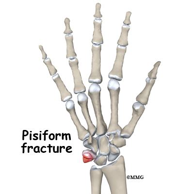 pisiform bone