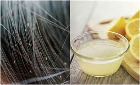Eliminate Lice With These Effective Homemade Remedies Women Daily