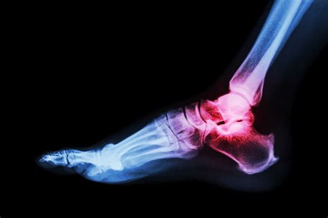 arthritis   ankle feel  footsurgeon