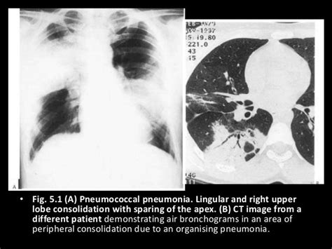 5 Pulmonary Infections
