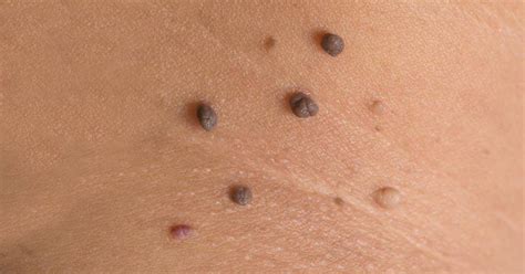 how hanging moles are removed from the skin facial mole