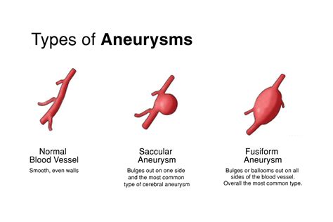 aortic aneurysm symptoms  repair role  axiostat