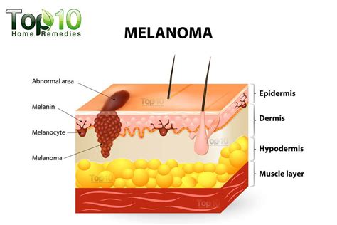 What Are The Signs And Symptoms Of Melanoma Skin Cancer Melanoma