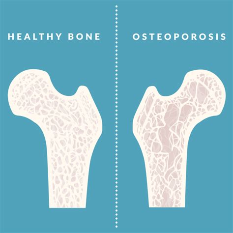 osteoporosis treatment symptoms medication