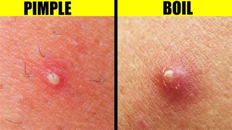 difference   pimple   boil youtube