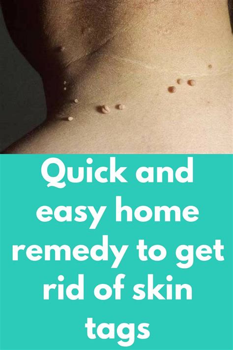 quick and easy home remedy to get rid of skin tags skin tags are