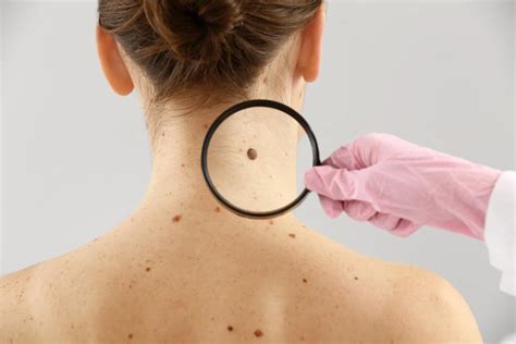 kanker kulit pengertian diagnosis pengobatan hello sehat