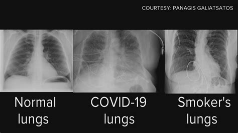 covid lungs  smoking lungs long term effects  covid  lungs