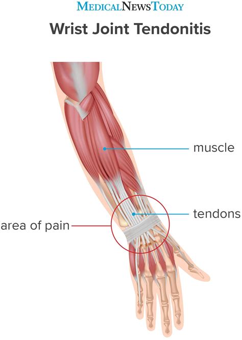 wrist tendonitis treatment symptoms