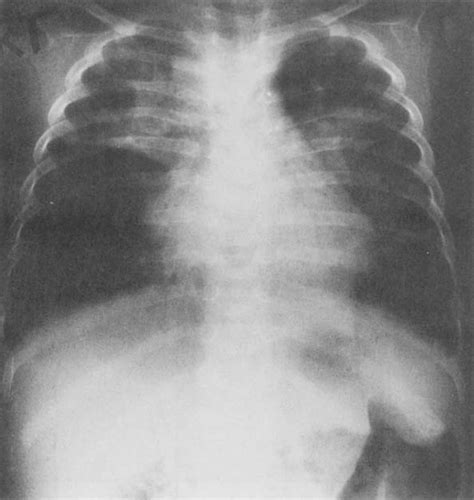 Chest Radiograph Consolidation Collapse Of The Right Upper Lobe With