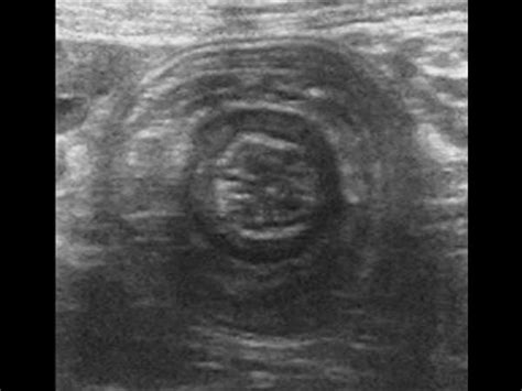 abdomen and retroperitoneum 1 6 gastrointestinal tract case 1 6 7