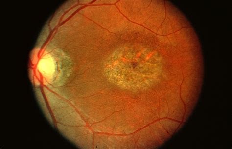 stargardts disease retina image bank