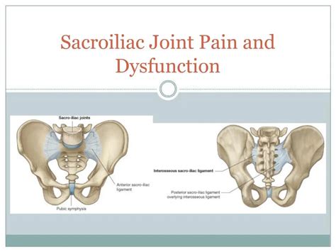 sacroiliac joint pain  dysfunction powerpoint
