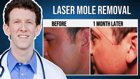 laser mole removal  procedure youtube