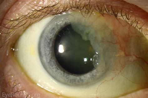 ocular surface squamous cell carcinoma