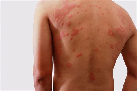what other conditions may mimic hives