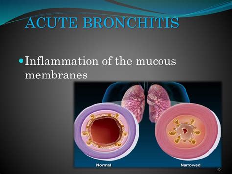 a case presentation on acute bronchitis