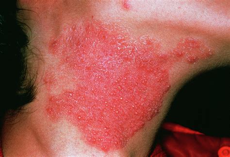 fungal skin infection  photograph  cnriscience photo library pixels