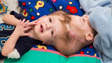 Conjoined Twins At The Head Prepare To Be Separated