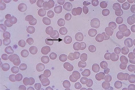 peripheral smear  case  thalassemia target cell
