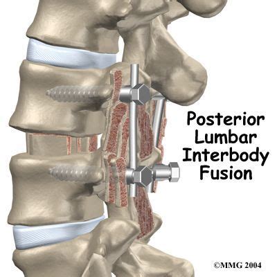 surgery plif posterior lumbar interbody fusion    ll   spinal