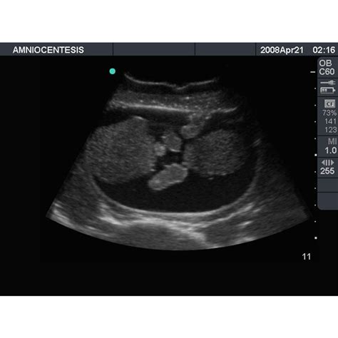 abp amniocentesis ultrasound training model adamrouilly