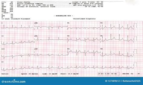 Cardiogram Waveform From An Ekg Showing Abnormal Ekg Test A Patient