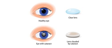cataract surgery which is the better lens multifocal or monofocal
