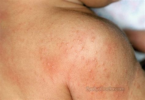 heat rash symptoms treatment pictures cure remedies