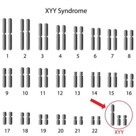 47 Xyy Syndrome Medlineplus Genetics