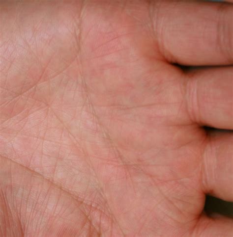 eczema  care   hands dr trevor erikson