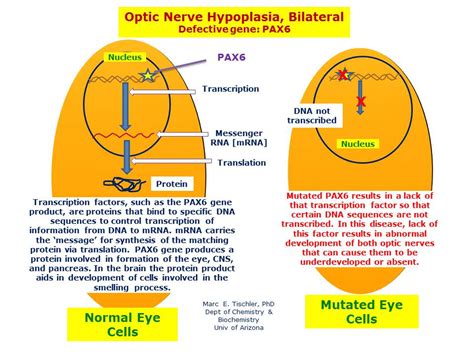 optic nerve hypoplasia bilateral hereditary ocular diseases